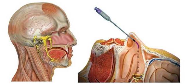 sphenocath24